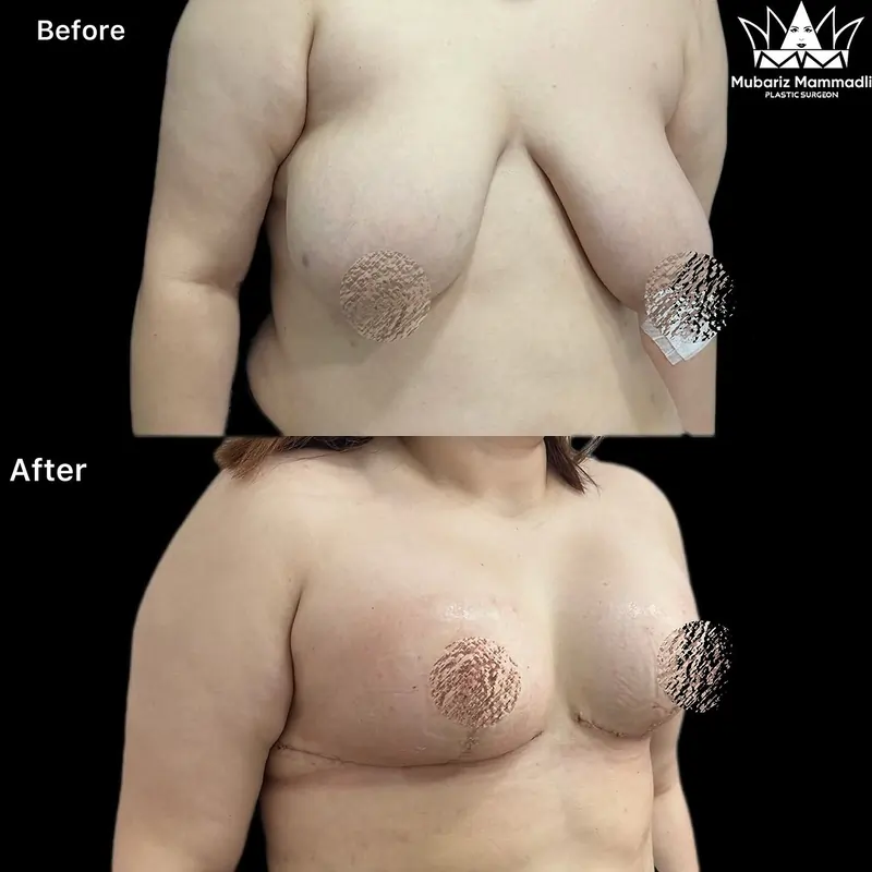 PostOp 11 after asymmetric breast lift.